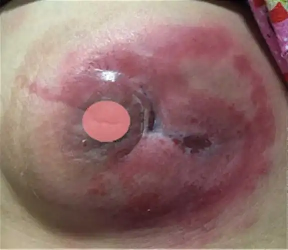 儋州市乳腺炎专家_儋州市治疗乳腺炎哪个专家好_儋州市治疗乳腺炎最好