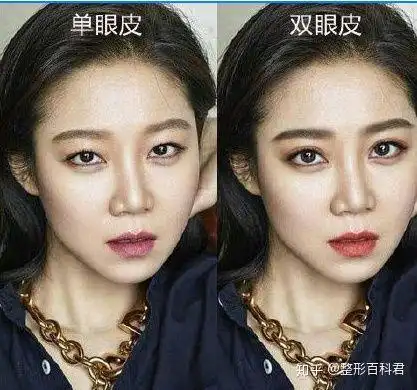 为什么好多单眼皮女孩要割双眼皮?