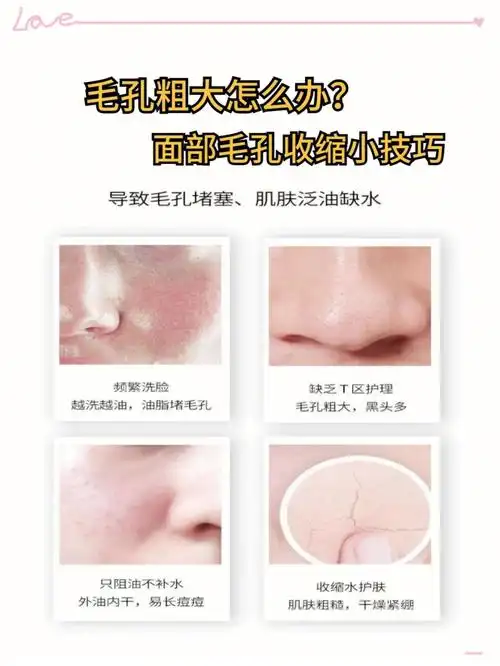 毛孔粗大怎么办面部毛孔收缩小技巧超详细