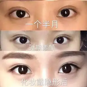 埋线双眼皮手术真实案例_整容日记_整形前后对比照_【经典整形网】