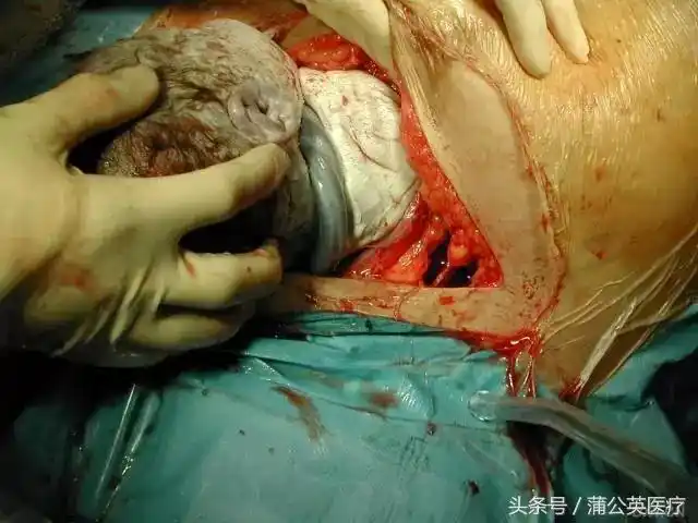 5,孩子的头看到了4,准备剪开那层胎膜3,肚皮划开了,里面的是子宫,孕育