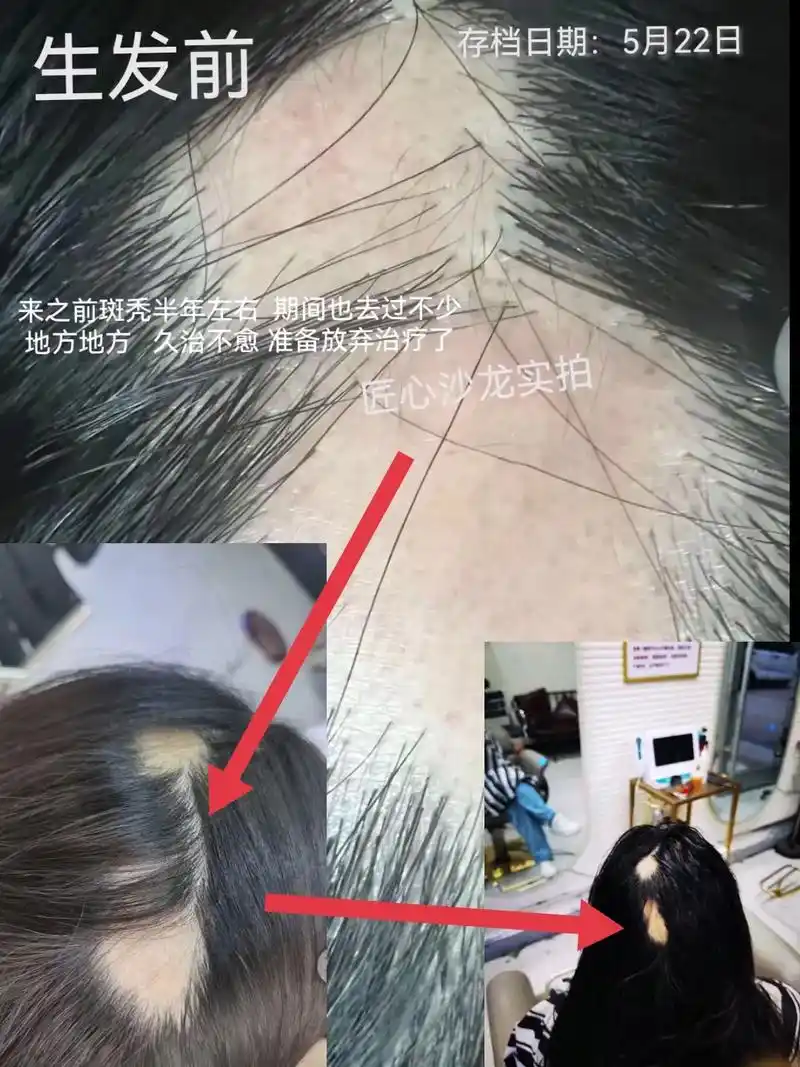 防脱生发 #养发护发 #斑秃 #头发 - 抖音