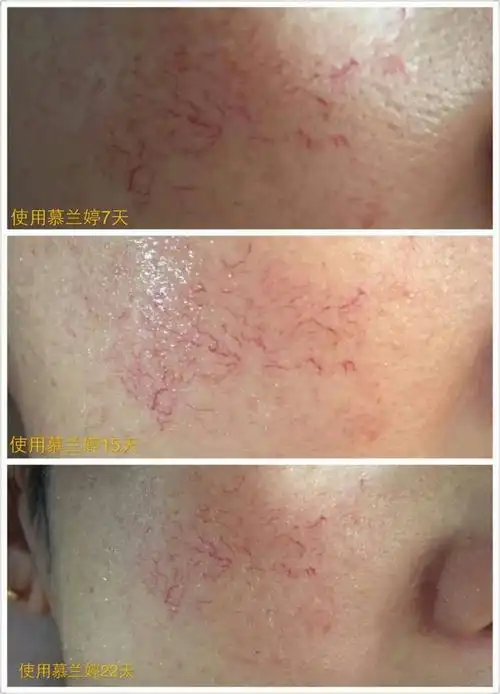 够实力才敢发出来,慕兰婷实力对抗红血丝,敏感肌,激素脸!