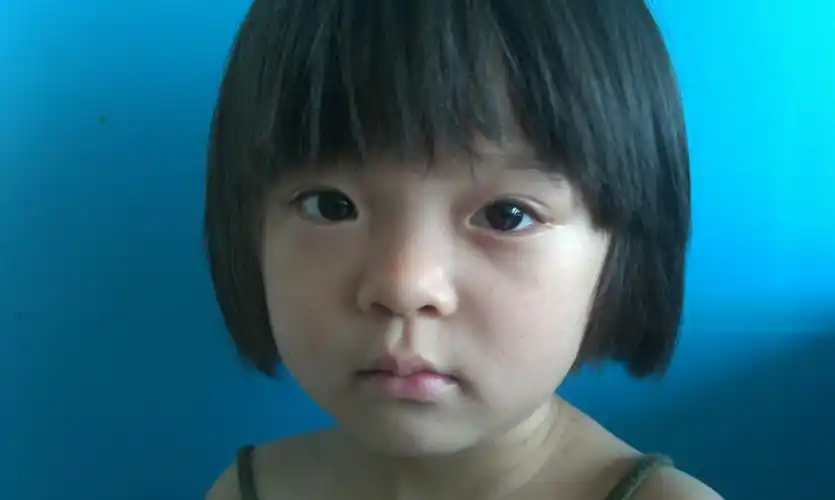 先天性的小孩上睑下垂(大小眼)能矫正吗?