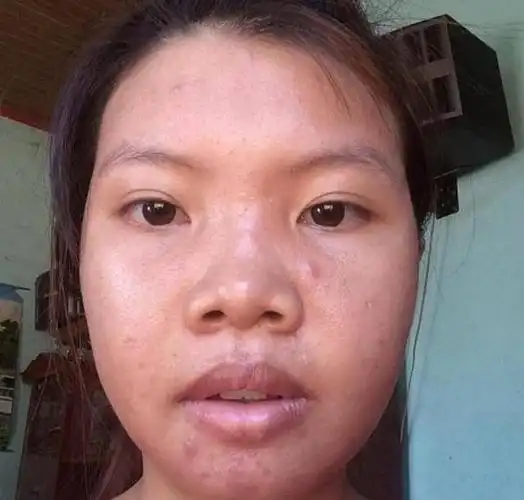 因为长相女子曾多次被丑拒狠心斥巨资整容终嫁富二代