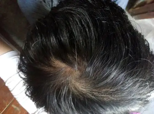 头秃得好厉害,怎么办?