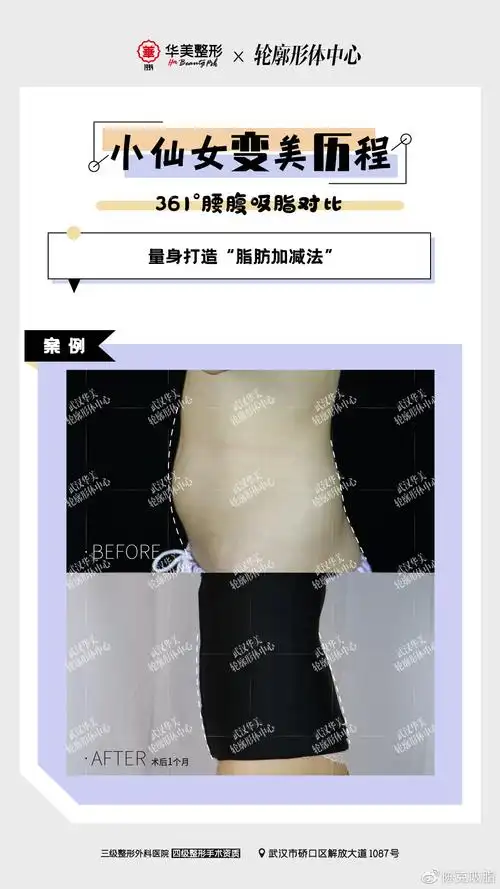 涨姿势吸脂后脂肪没了皮肤会不会松弛垮掉