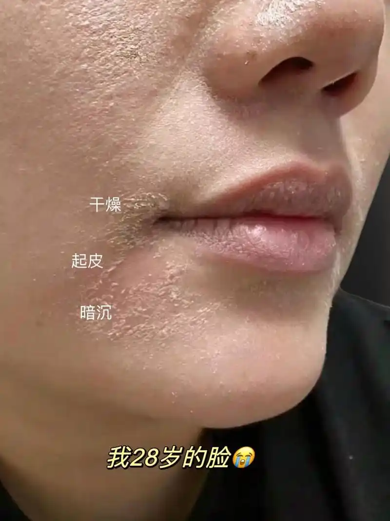 换季不保养,皮肤干燥粗糙又显老! 还在为脸上干燥起皮暗沉而烦 - 抖音