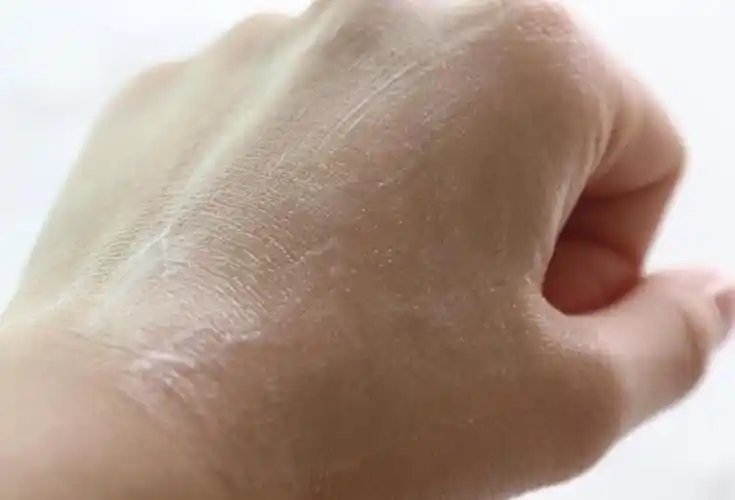 冬季肌肤干燥缺水_最需要温和的去角质产品