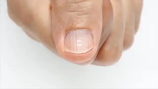 在正常的情况下,指甲和甲床是紧密贴合的,但是在指甲和皮肤褶皱的连接