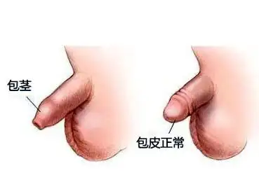 包皮包茎容易并发的疾病
