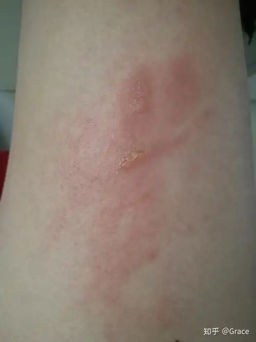 记录被95开水烫伤的一个月