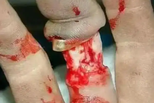 戴戒指打保龄球不安全手上的肉可能刮掉同时损坏戒指