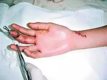 真剁手了该怎么办两个急救要点教你挽回断肢