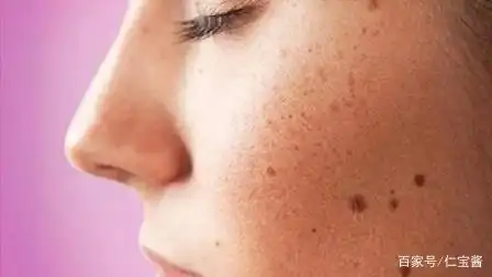 一分钟看清脸上的斑该怎么救!