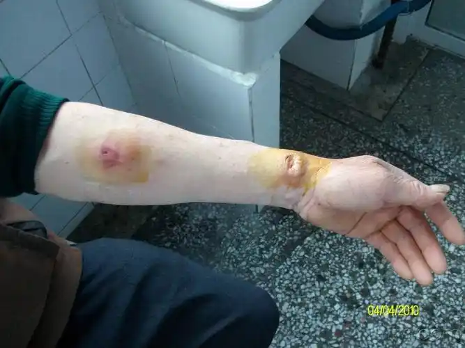 临床诊断 孢子丝菌病,病理诊断 皮炎伴溃疡 - 皮肤及性传播疾病讨论版