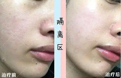 光子嫩肤祛红血丝治疗前后对比照