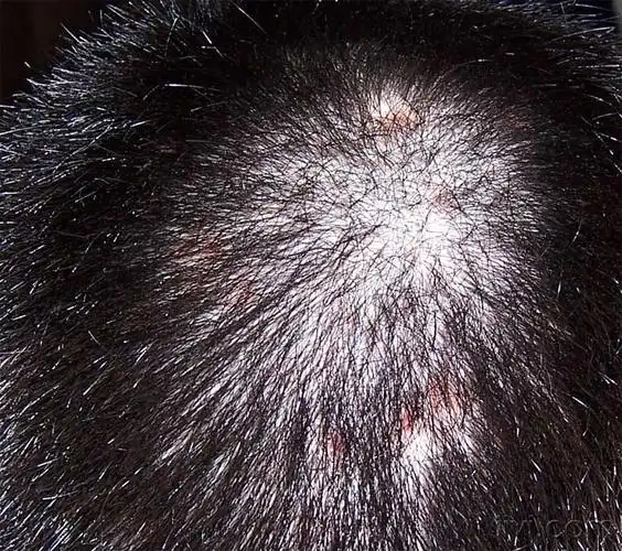 头皮毛囊炎?多图,几家三甲医院没看好
