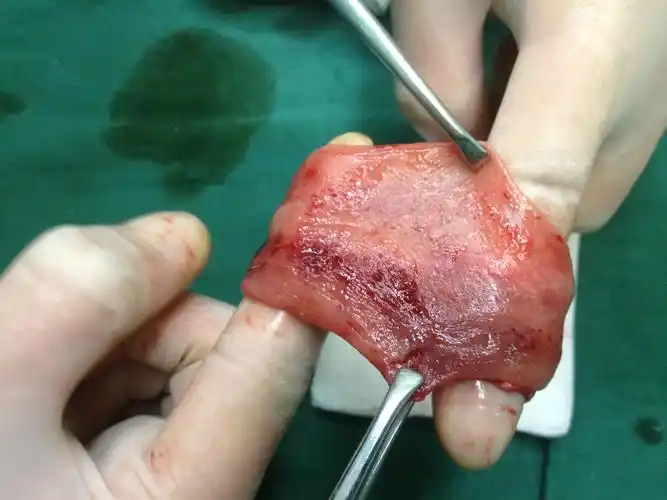 直肠脱垂行pph术