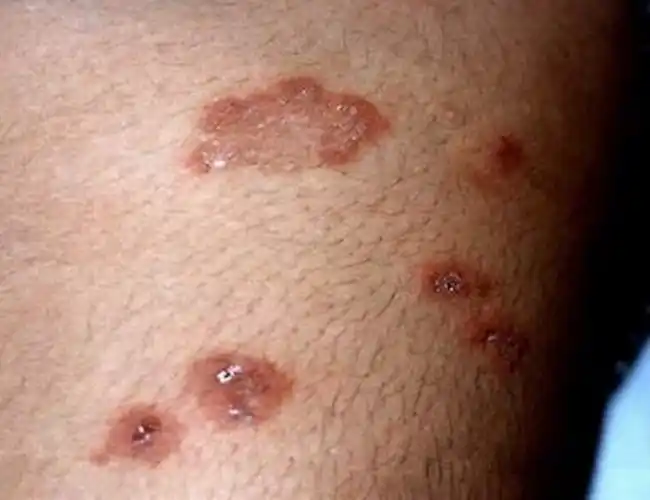 疱疹样皮炎局部症状图片