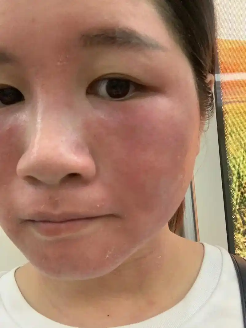 激素脸  #敏感肌  #修复红血丝角质层薄  #问题性皮肤 - 抖音