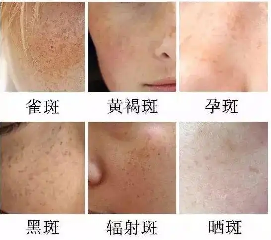 晒斑,老年斑,色素痣等