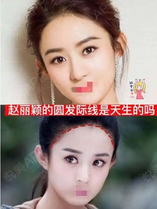 赵丽颖的圆发际线是天生的吗