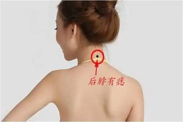 脖子后面长痣