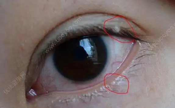 上眼皮里面长了个疙瘩上眼皮里长了个小白点多图