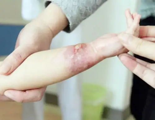 小心谨慎,但是意外总是很难控制,因此孩子经常会受到伤害,比如说烫伤