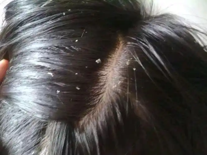 如何知道自己头皮有没有螨虫(头皮上的白泥是什么)