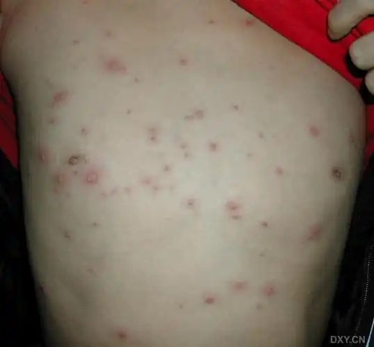 [原创 ]一例非常典型的 水痘 患儿病例照片! [病例帖]