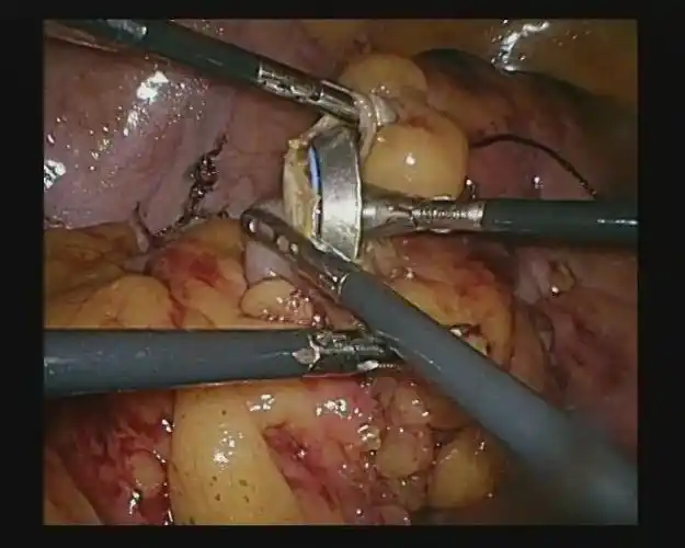 将吻合器钉头放入降结肠