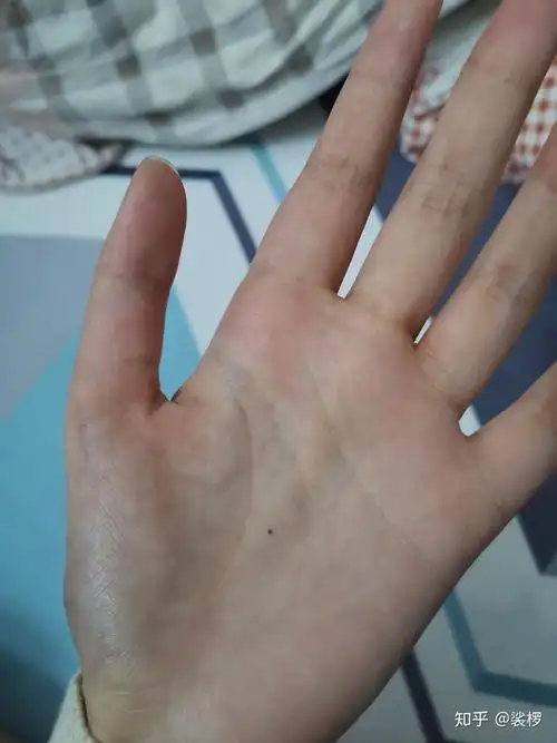 手心里突然长了一颗小痣代表什么?