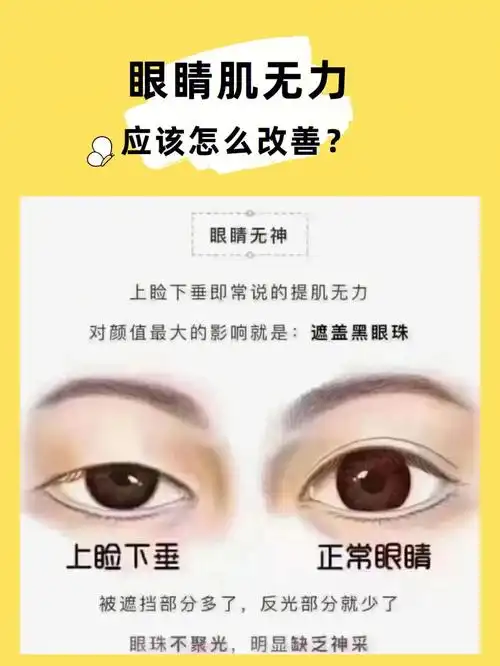 眼睛肌无力怎么改善?