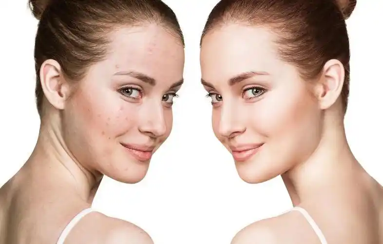 面部皮肤干燥的年轻女性