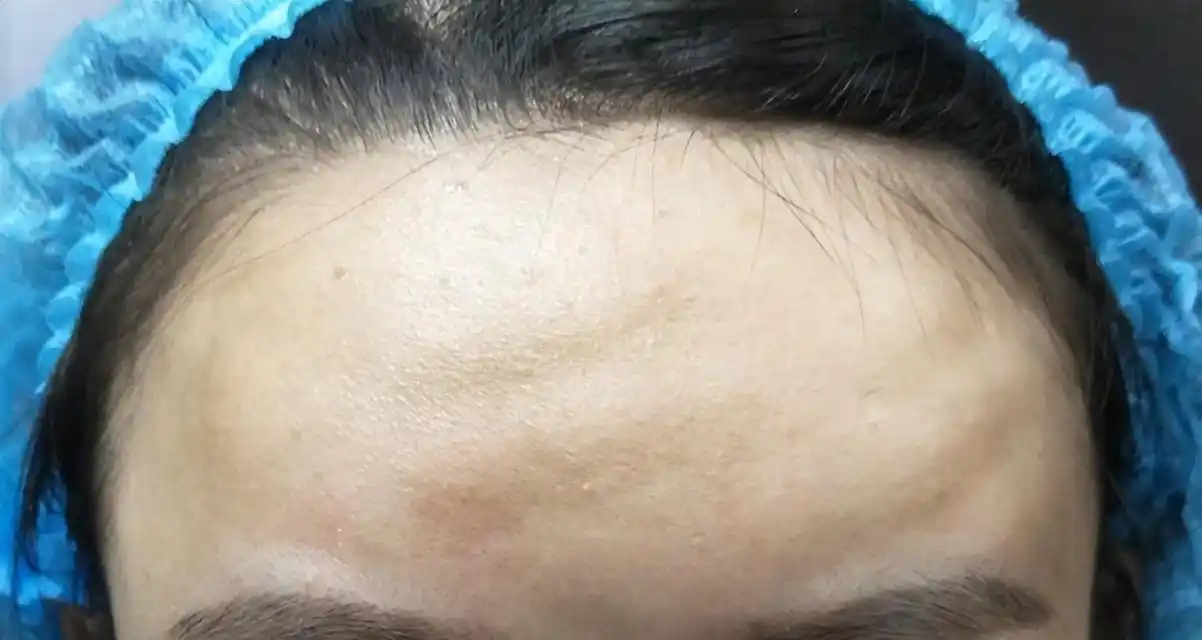 面部脂肪填充失败案例图片,看完你还敢随便做填充吗?