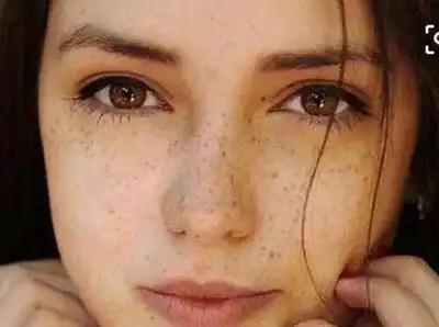 脸上色斑多 3d脉冲祛斑不反弹!