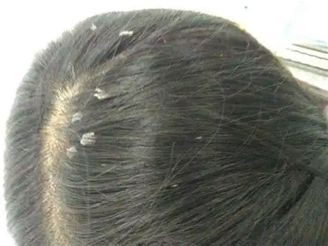 头屑多头皮痒用醋洗可以吗头屑多头皮痒怎么办用什么洗最好2022已更新