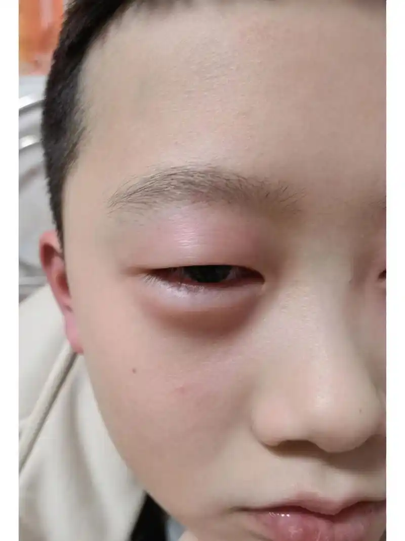 儿子老是眼睛上长疙瘩,还痒,像是过敏的症状,但为什么老是过敏在眼睛