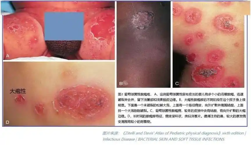 皮肤及软组织感染诊治大全毛囊炎疖痈蜂窝织炎丹毒等