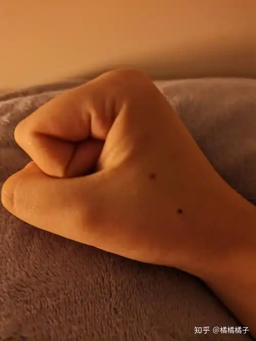 虎口上有痣的人会怎么样? - 知乎