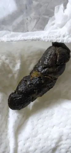 问:一岁宝宝奶粉喂养加辅食,拉便便一直黑色是怎么回事?拉屎很费劲.