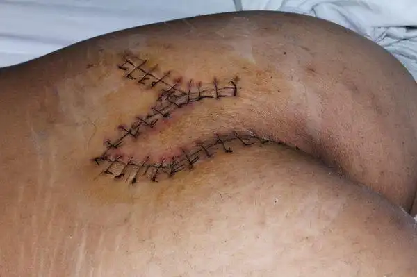 藏毛窦囊肿切除转移皮瓣成型术