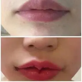 多亏成都玉颜刘玉辉院长才能从小厚唇变身微笑嘟嘟唇整形案例 - 成都