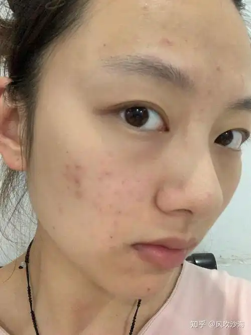 怎么看待五官漂亮但是皮肤差的女性?