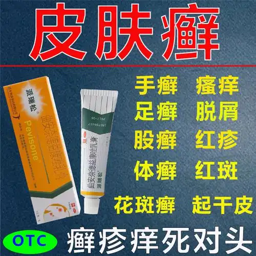 派瑞松软膏曲安奈德益康唑乳膏皮炎体癣花斑癣皮肤癣手足癣病药膏