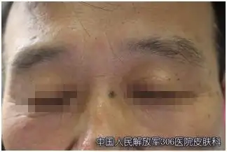 皮肤镜"活眼金睛" 无创辨肿瘤