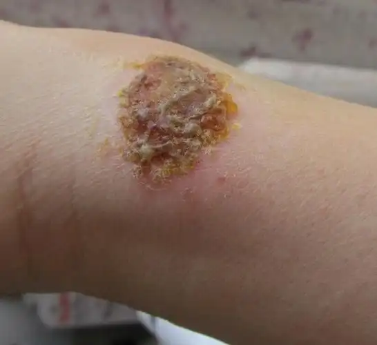 早期银屑病症状图片_银屑病求医网