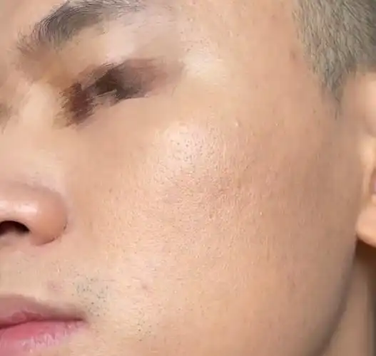 油性,毛孔粗大,有黑头的男生怎么保养皮肤?